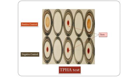 tpha test cost|Treponema Pallidum Hemagglutination ( TPHA ) Test : Bloodoxy.